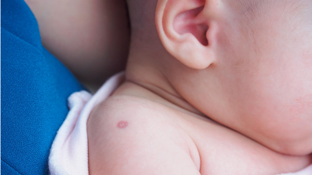 tuberculose shutterstock