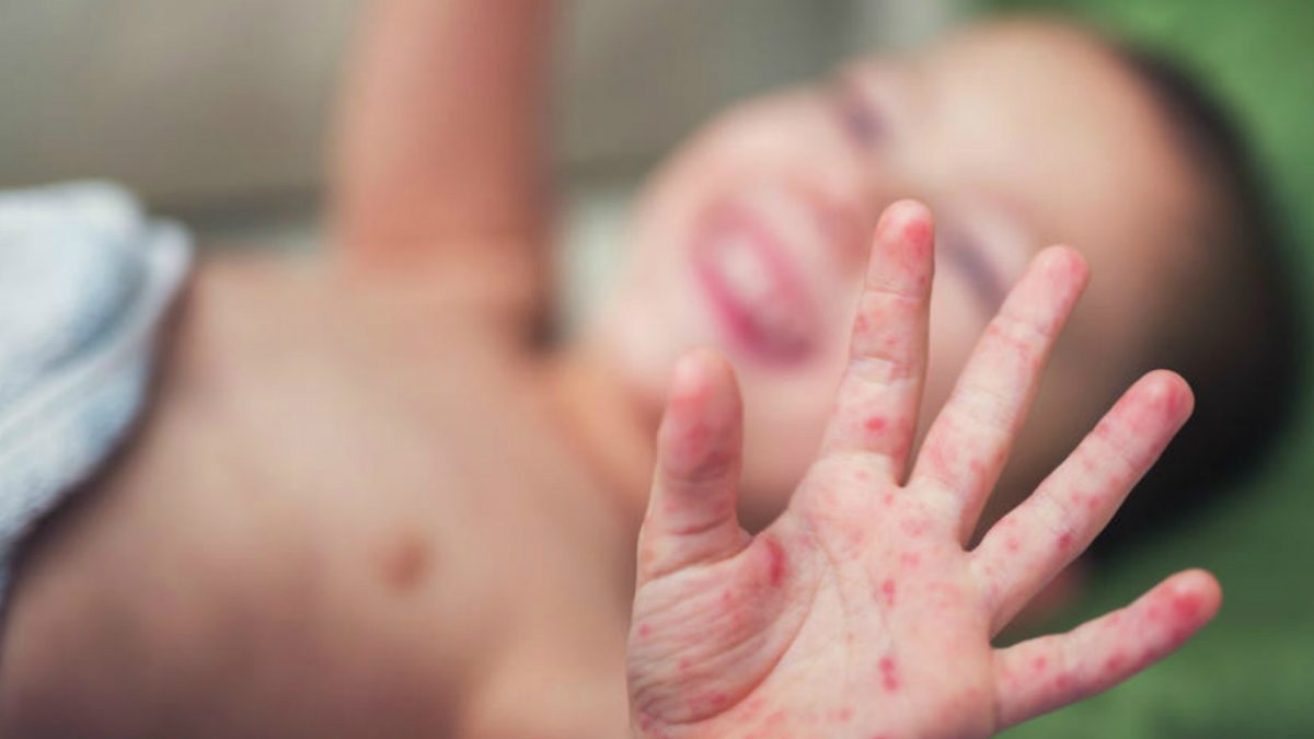 sarampo-Shutterstock