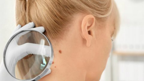 cancro pele associação cutâneo mitos sol