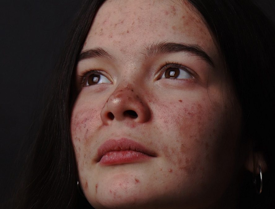 acne