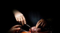 transplamte de rim cinco anos lista de espera