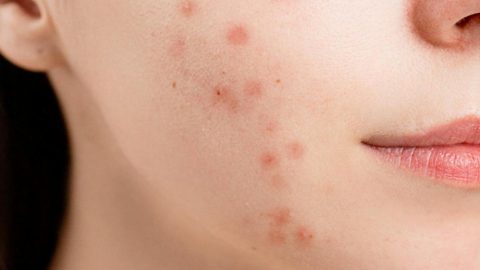 acne produtos substância química benzeno