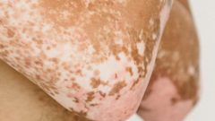 psoríase genéritica estudo doença