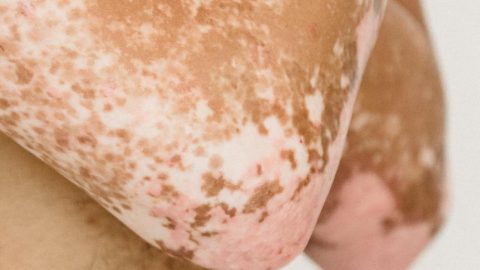 psoríase genéritica estudo doença