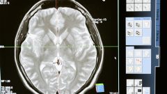 Obesidade Alzheimer estudo semelhanças cérebro