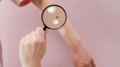 cancro pele estudo inovação champalimaud