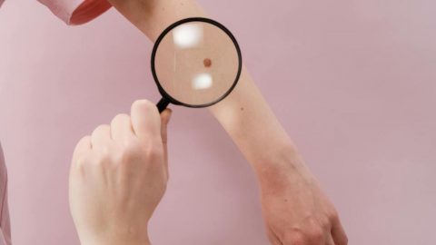 cancro pele estudo inovação champalimaud